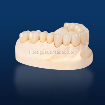 Na -customize na multilayered zirconia para sa pagpapanumbalik ng ngipin